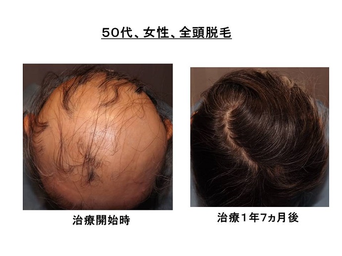 円形脱毛症　病院""